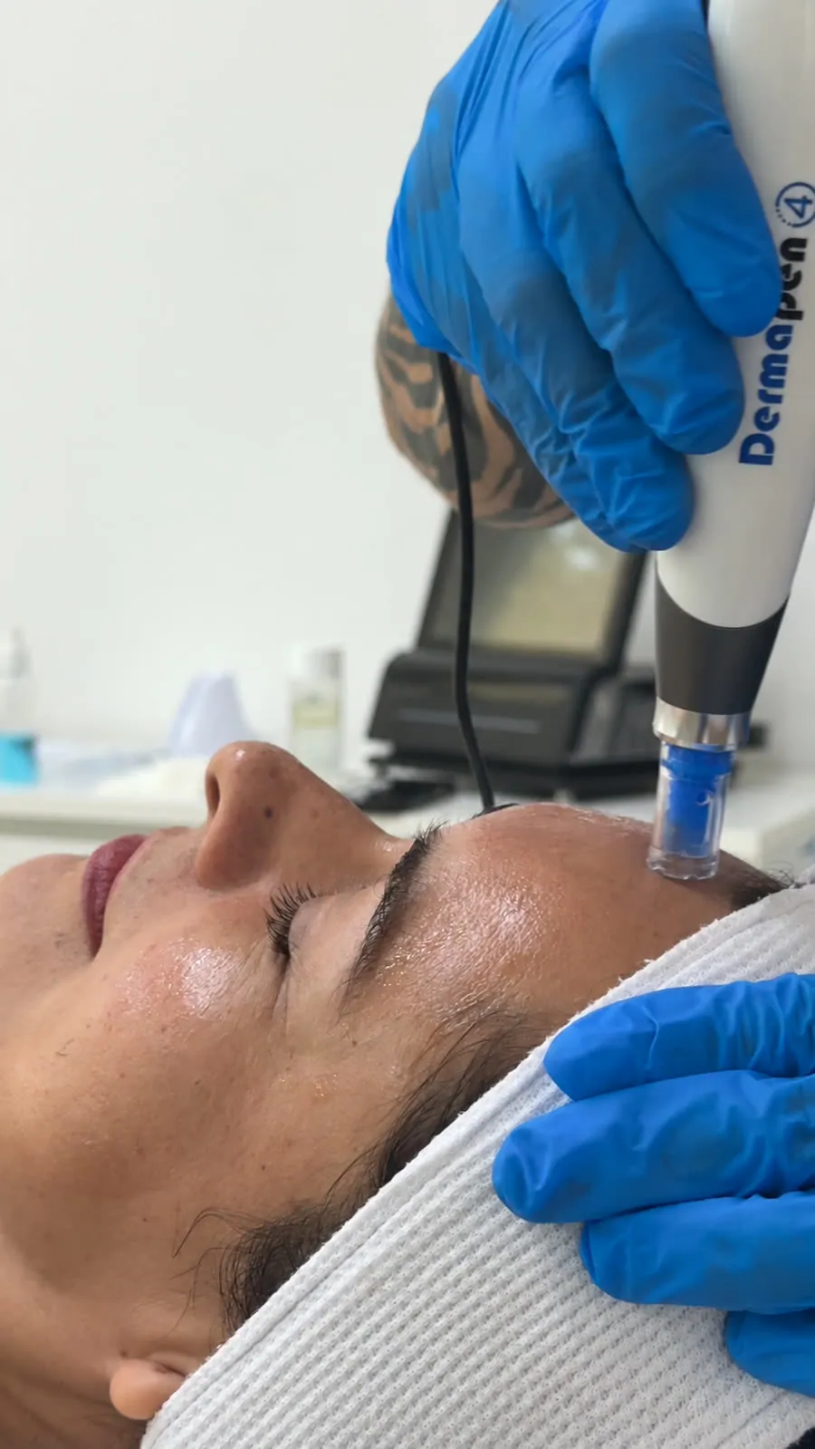 Tratamiento con Dermapen en Valanka